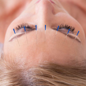 accupuncture-cardiff-encinitas