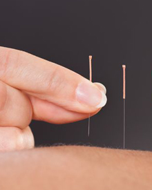 Stress Buster Acupuncture in San Marcos